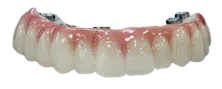 Fixed temporary teeth placed on All-on-4 implants