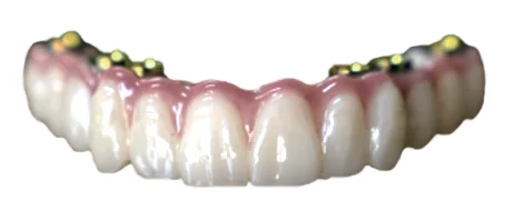 Zirconia bridge on titanium cylinders