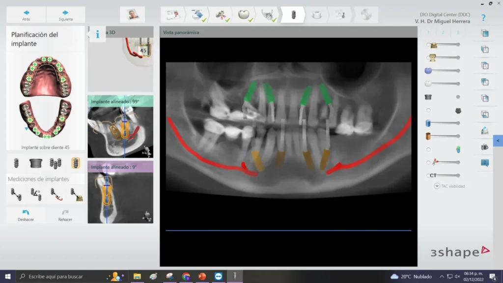 Panoramic X-ray used for All-on-4 implant planning