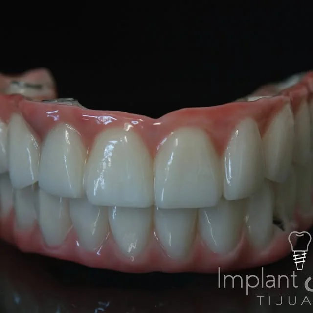 Zirconia full-arch bridge close-up made in our lab